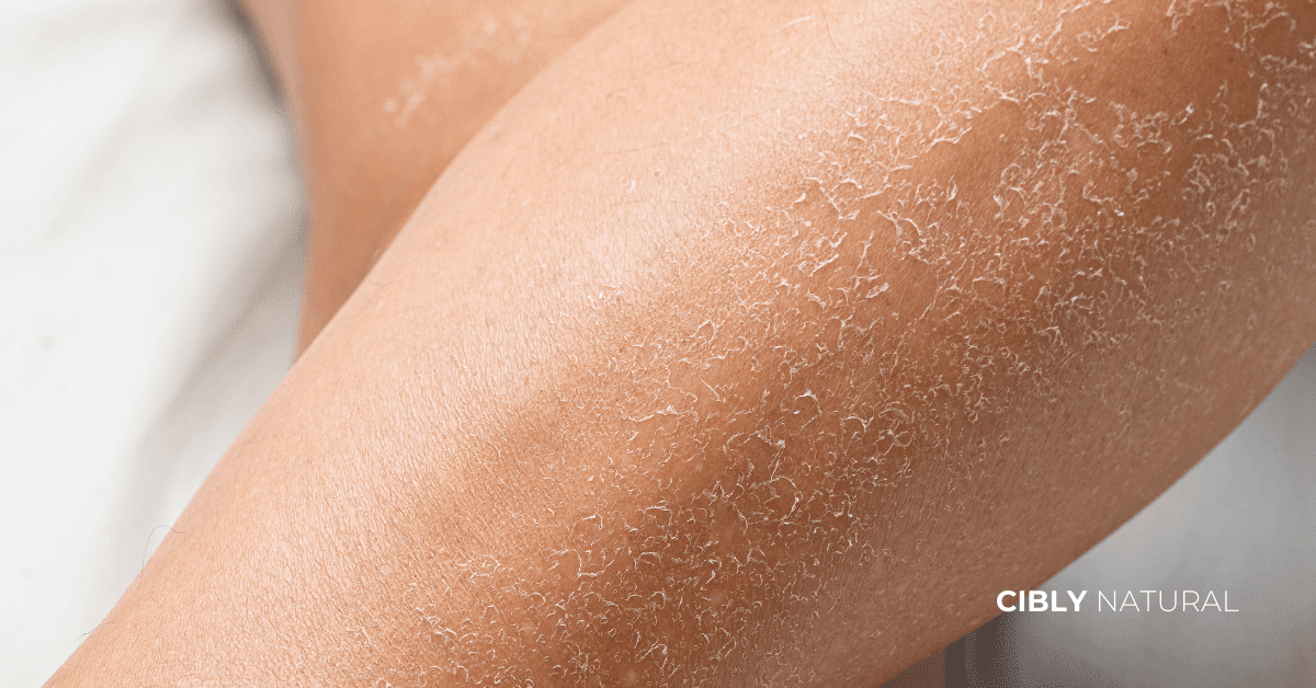 Суха кожа характеристики – текстура, люспене и нужда от хидратация