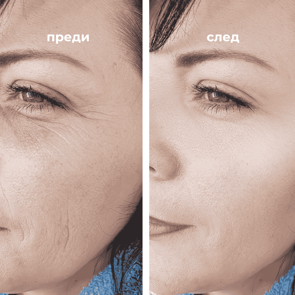 Сравнение преди и след инжектиране на хиалуронова киселина – видими резултати за попълване на бръчки