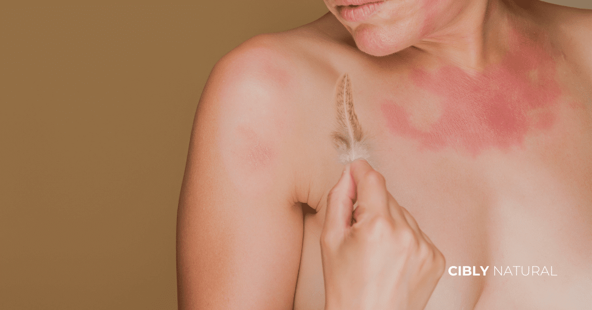 Жена с раздразнена кожа и зачервявания – симптоми на barrier damage