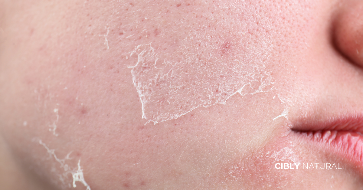 Схема на кожната бариера – здрава структура с церамиди vs нарушена бариера с пролуки